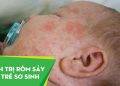 cách trị rôm sảy cho trẻ sơ sinh